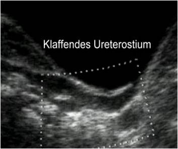 Klaffendes Ureterostium bei Refluxnephropathie